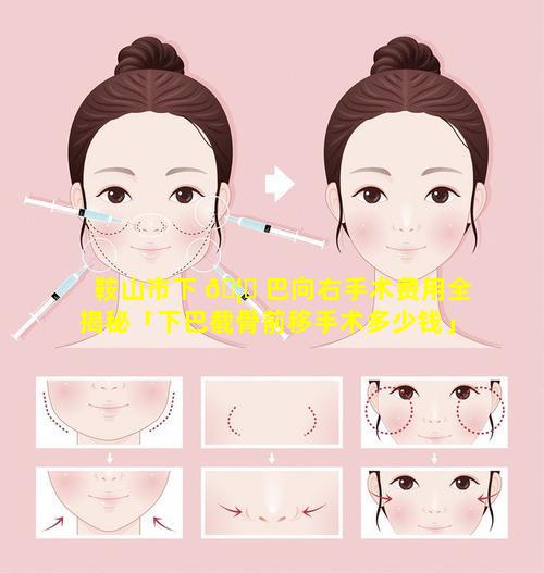 鞍山市下 🦉 巴向右手术费用全揭秘「下巴截骨前移手术多少钱」